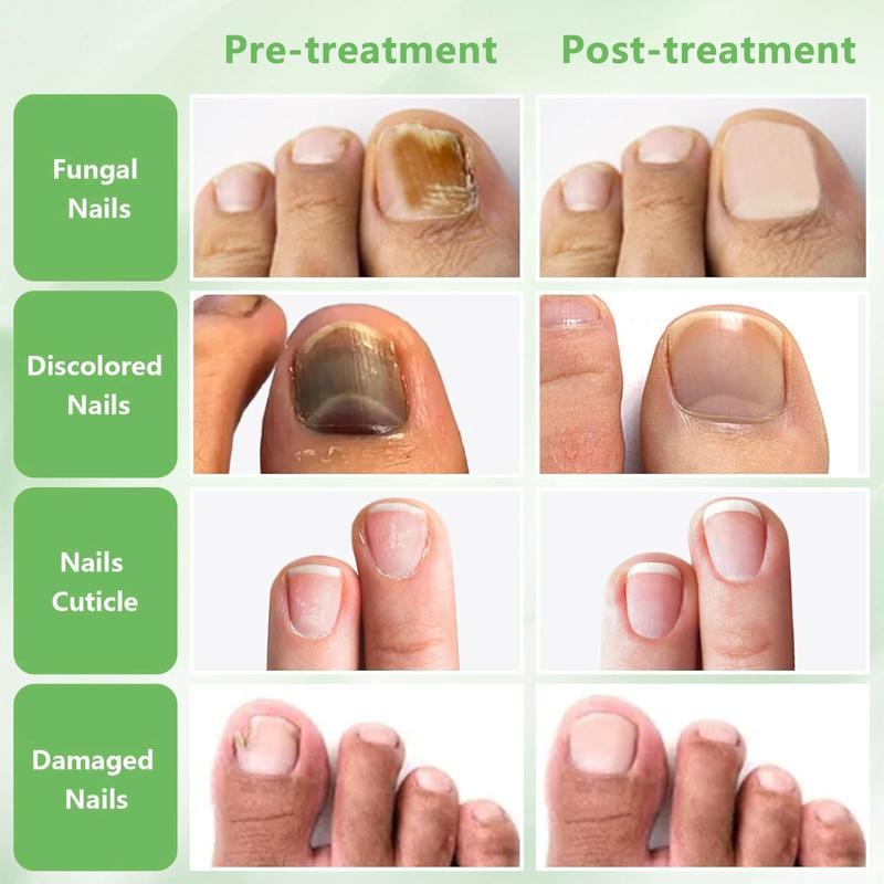 Ginger Nail Treatment NailSupport Nail Care nail support - Repair and StrengthenforClowing, Beautiful Nails