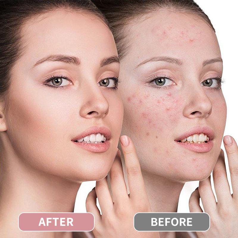 VGO Acne Removal Cream - Natural Essence with Azelaic Acid & Salicylic Acid - Skin Care Serum for Acne & Dark Scars