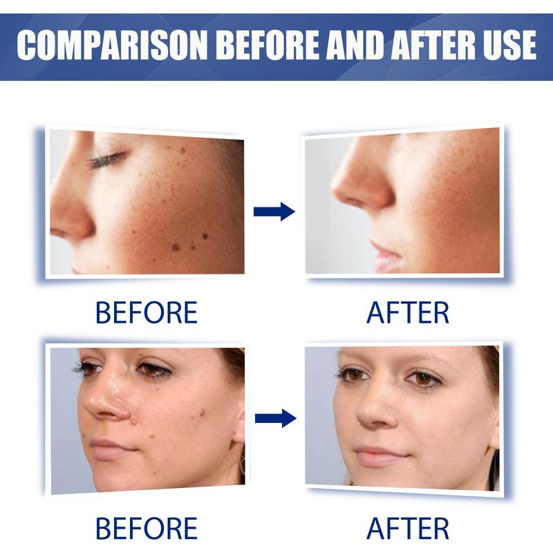 EELHOE Skin Label Removal Cream - Corneous Warts Flat Removal Cleansing Skin Kayu Cream - Moisturizers Skincare Smooth