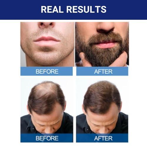 3 MONTHS KIRKLAND MINOXIDIL 5% MENS HAIR LOSS REGROWTH GENERIC TREATMENT Gentle Hair Care Gentle Hair Care