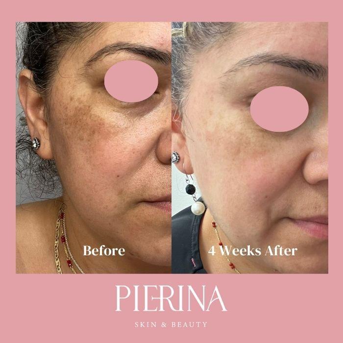 Anti-Melasma Even Skin System