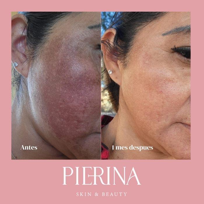 Anti-Melasma Even Skin System