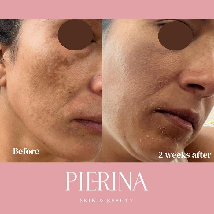 Anti-Melasma Even Skin System