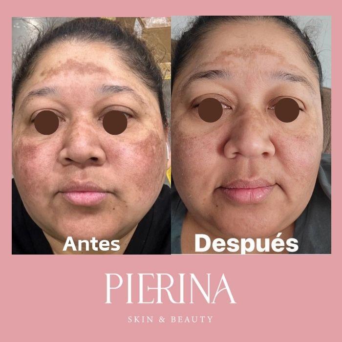 Anti-Melasma Even Skin System