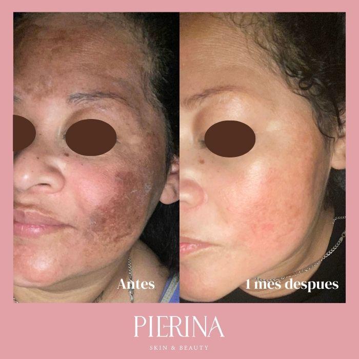 Anti-Melasma Even Skin System